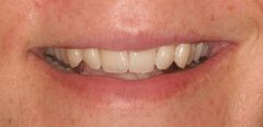 Close-up of teeth before treatment in Phoenix, AZ | 24th Street Dental Biltmore