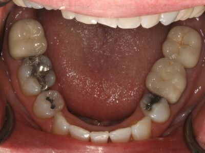 Close-up of teeth dental treatment in Phoenix, AZ | 24th Street Dental Biltmore