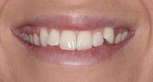 Close-up of teeth after treatment in Phoenix, AZ | 24th Street Dental Biltmore
