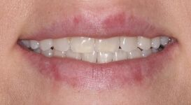 Close-up of teeth after metal braces in Phoenix, AZ | 24th Street Dental Biltmore