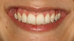 Close-up of teeth after treatment in Phoenix, AZ | 24th Street Dental Biltmore