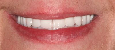 Teeth treatment images showcasing dental health improvement in Phoenix, AZ | 24th Street Dental Biltmore