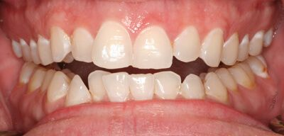 Close-up of teeth before treatment in Phoenix, AZ | 24th Street Dental Biltmore