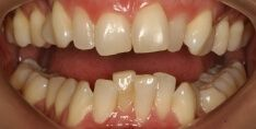 Close-up of teeth before treatment in Phoenix, AZ | 24th Street Dental Biltmore