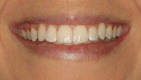 Close-up of teeth after treatment in Phoenix, AZ | 24th Street Dental Biltmore