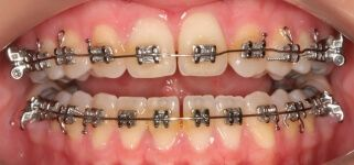Close-up of teeth before metal braces in Phoenix, AZ | 24th Street Dental Biltmore