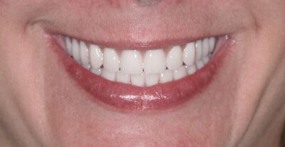 Teeth treatment images showcasing dental health improvement in Phoenix, AZ | 24th Street Dental Biltmore