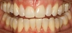 Close-up of teeth after treatment in Phoenix, AZ | 24th Street Dental Biltmore