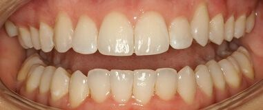 Close-up of teeth before treatment in Phoenix, AZ | 24th Street Dental Biltmore