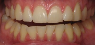 Close-up of teeth before treatment in Phoenix, AZ | 24th Street Dental Biltmore