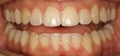 Close-up of teeth before treatment in Phoenix, AZ | 24th Street Dental Biltmore