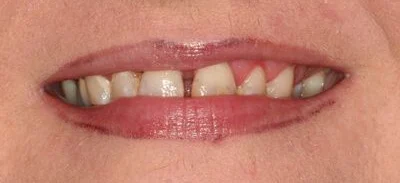 Close-up of teeth before treatment in Phoenix, AZ | 24th Street Dental Biltmore