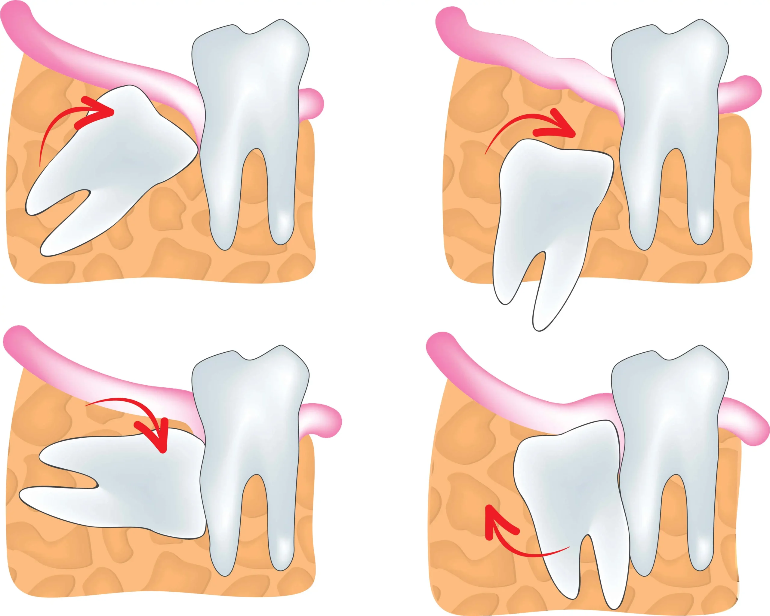 Wisdom Tooth Extraction Stages illustration | 24th Street Dental Biltmore in Phoenix, AZ | 24th Street Dental Biltmore