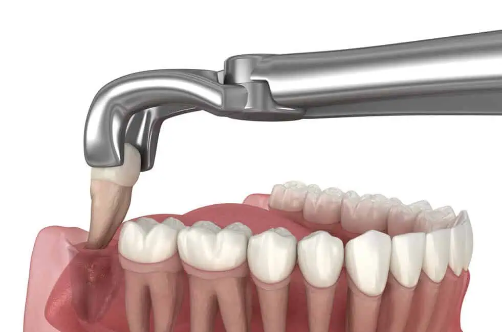 Wisdom Teeth by 24 Street Dental in phoenix, AZ