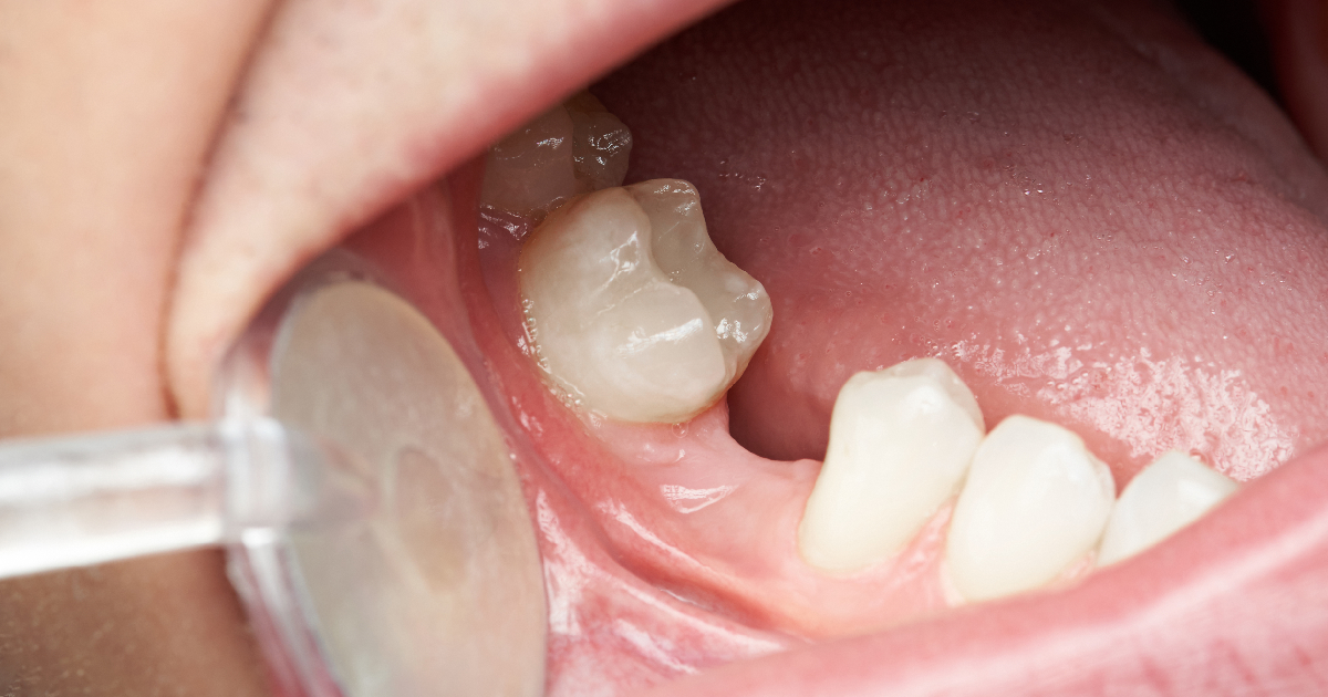 Close-up of missing tooth gap in lower jaw during dental exam in Phoenix, AZ | 24th Street Dental Biltmore