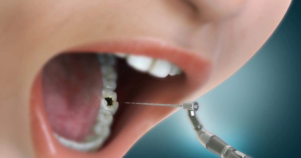 Close-up of root canal procedure treating an infected tooth in Phoenix, AZ | 24th Street Dental Biltmore