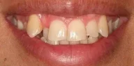 Close-up of teeth before treatment in Phoenix, AZ | 24th Street Dental Biltmore