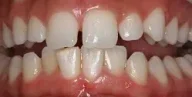 Close-up of teeth before treatment in Phoenix, AZ | 24th Street Dental Biltmore