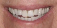 Close-up of teeth after treatment in Phoenix, AZ | 24th Street Dental Biltmore