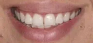 Close-up of teeth before treatment in Phoenix, AZ | 24th Street Dental Biltmore