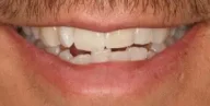 Close-up of teeth before treatment in Phoenix, AZ | 24th Street Dental Biltmore