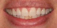 Close-up of teeth before treatment in Phoenix, AZ | 24th Street Dental Biltmore
