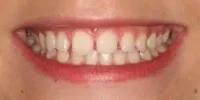 Close-up of teeth dental treatment in Phoenix, AZ | 24th Street Dental Biltmore
