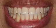 Close-up of teeth after treatment in Phoenix, AZ | 24th Street Dental Biltmore