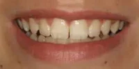 Close-up of teeth dental treatment in Phoenix, AZ | 24th Street Dental Biltmore