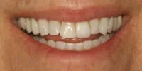 Close-up of teeth before treatment in Phoenix, AZ | 24th Street Dental Biltmore