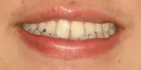 Close-up of teeth after treatment in Phoenix, AZ | 24th Street Dental Biltmore