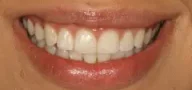 Close-up of teeth after treatment in Phoenix, AZ | 24th Street Dental Biltmore