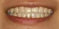 Close-up of teeth after treatment in Phoenix, AZ | 24th Street Dental Biltmore