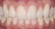 Close-up of teeth after treatment in Phoenix, AZ | 24th Street Dental Biltmore
