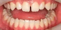 Close-up of teeth before treatment in Phoenix, AZ | 24th Street Dental Biltmore