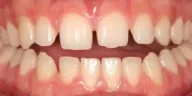Close-up of teeth dental treatment in Phoenix, AZ | 24th Street Dental Biltmore