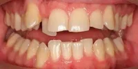 Close-up of teeth before treatment in Phoenix, AZ | 24th Street Dental Biltmore