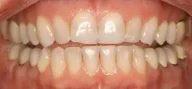 Close-up of teeth before treatment in Phoenix, AZ | 24th Street Dental Biltmore