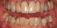 Close-up of teeth before Treatment in Phoenix, AZ | 24th Street Dental Biltmore