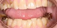 Close-up of stained teeth before Treatment in Phoenix, AZ | 24th Street Dental Biltmore