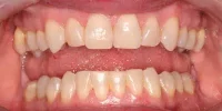Yellow teeth before whitening in Phoenix, AZ | 24th Street Dental Biltmore