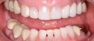 Yellow teeth before treatment in Phoenix, AZ | 24th Street Dental Biltmore