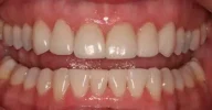 Yellowed teeth before dental cleaning in Phoenix, AZ | 24th Street Dental Biltmore