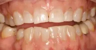 Teeth with plaque buildup before cleaning in Phoenix, AZ | 24th Street Dental Biltmore