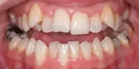 Severely stained and misaligned teeth in Phoenix, AZ | 24th Street Dental Biltmore