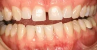Close-up of teeth before treatment in Phoenix, AZ | 24th Street Dental Biltmore