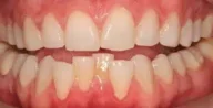 Close-up of teeth before treatment in Phoenix, AZ | 24th Street Dental Biltmore