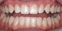 Close-up of teeth after treatment in Phoenix, AZ | 24th Street Dental Biltmore