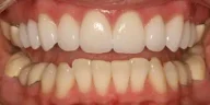 Close-up of teeth after treatment in Phoenix, AZ | 24th Street Dental Biltmore