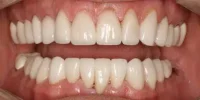 White teeth with even spacing in Phoenix, AZ | 24th Street Dental Biltmore